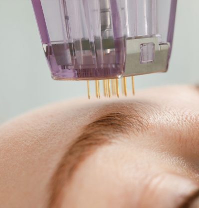 mbi-morpheus8-1 mbi-morpheus8-1