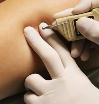 Neuromodulation,Of,A,Trigger,Point,Using,A,Pointer,Device.