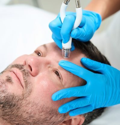 Beautician,Processes,The,Forehead,Of,A,Man,With,Co2,Laser